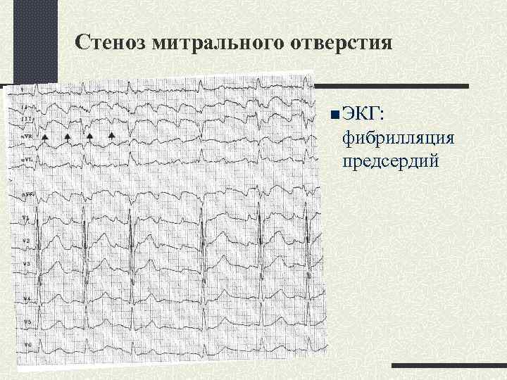 Стеноз митрального отверстия n ЭКГ: фибрилляция предсердий 