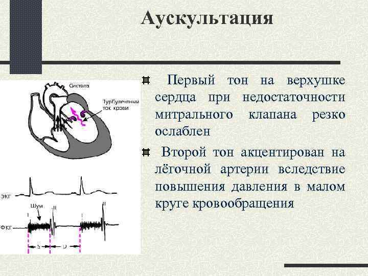 Аускультация Первый тон на верхушке сердца при недостаточности митрального клапана резко ослаблен Второй тон