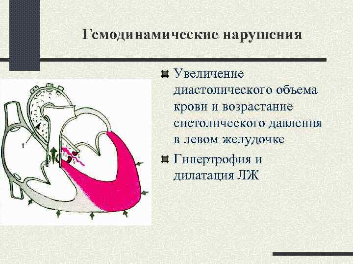 Гипертрофия и дилатация левого желудочка