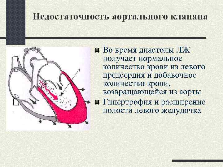 Недостаточность аортального клапана Во время диастолы ЛЖ получает нормальное количество крови из левого предсердия