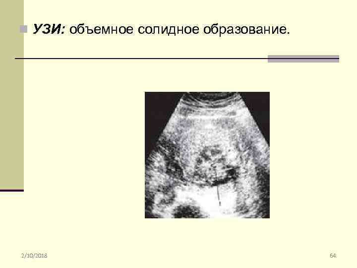 n УЗИ: объемное солидное образование. 2/10/2018 64 