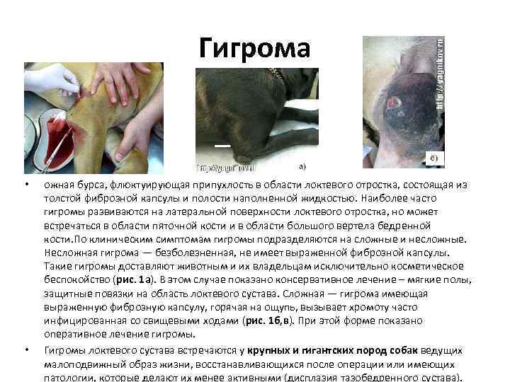 Гигрома • • ожная бурса, флюктуирующая припухлость в области локтевого отростка, состоящая из толстой