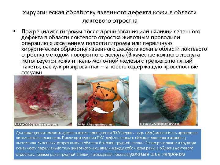 хирургическая обработку язвенного дефекта кожи в области локтевого отростка • При рецидиве гигромы после