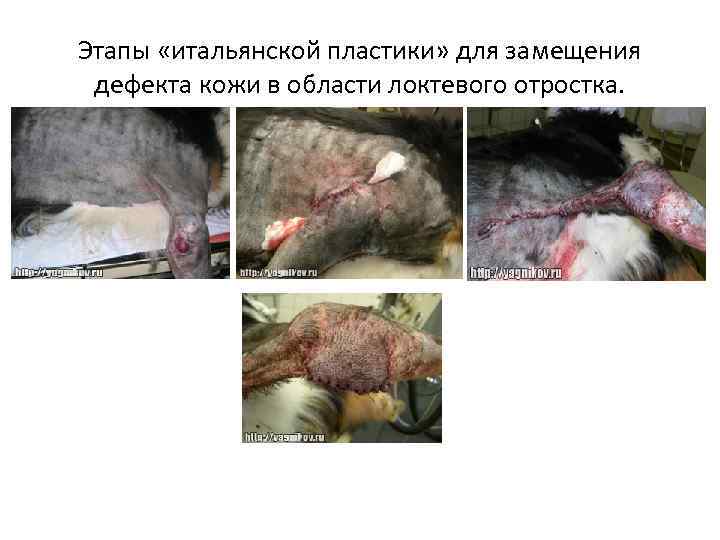 Этапы «итальянской пластики» для замещения дефекта кожи в области локтевого отростка. 