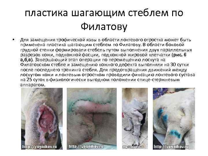 пластика шагающим стеблем по Филатову • Для замещения трофической язвы в области локтевого отростка