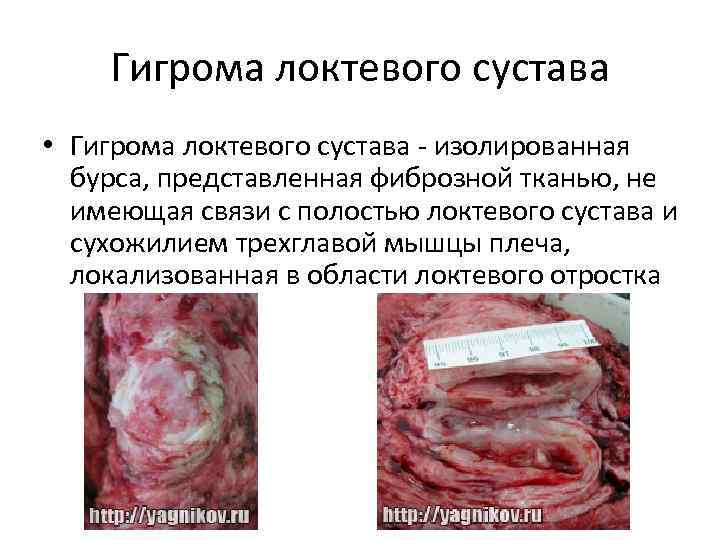 Гигрома локтевого сустава • Гигрома локтевого сустава - изолированная бурса, представленная фиброзной тканью, не