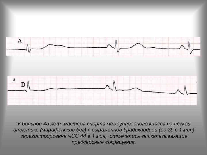 У больной 45 лет, мастера спорта международного класса по легкой атлетике (марафонский бег) с