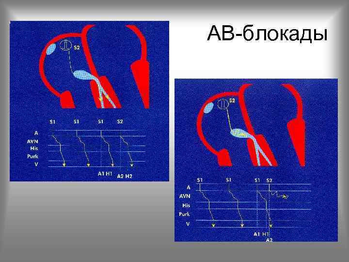 АВ-блокады 