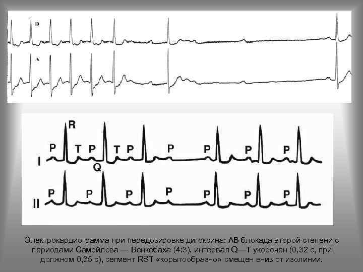 Электрокардиограмма при передозировке дигоксина: АВ блокада второй степени с периодами Самойлова — Венкебаха (4: