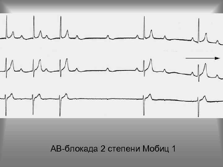 АВ-блокада 2 степени Мобиц 1 