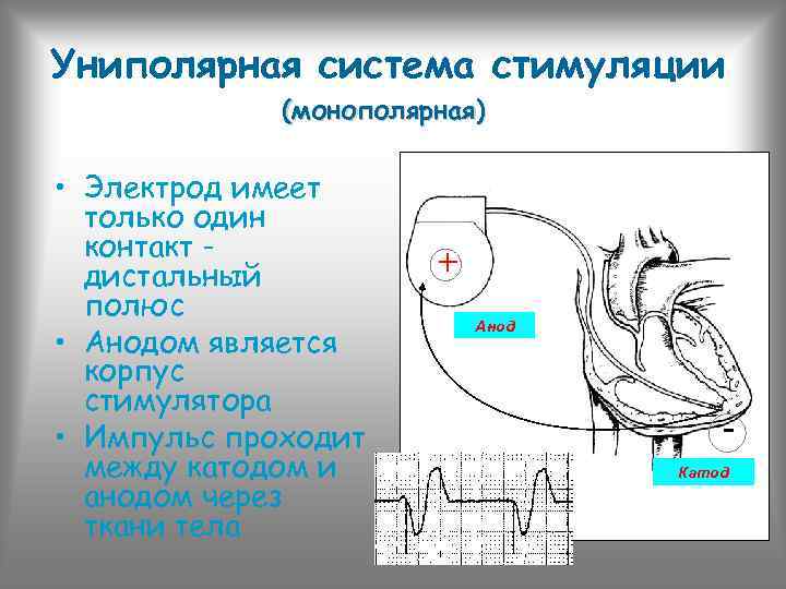 Униполярная система стимуляции (монополярная) • Электрод имеет только один контакт дистальный полюс • Анодом