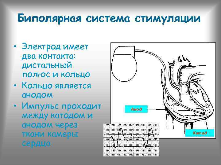 Биполярная система стимуляции • Электрод имеет два контакта: дистальный полюс и кольцо • Кольцо