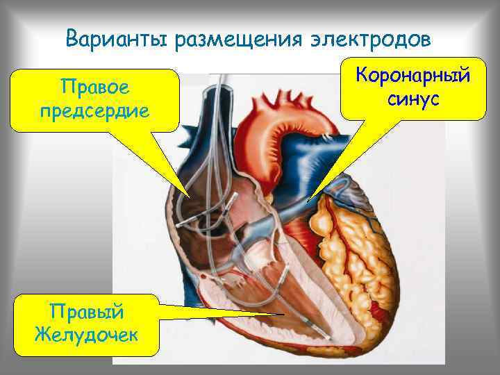 Варианты размещения электродов Правое предсердие Правый Желудочек Коронарный синус 