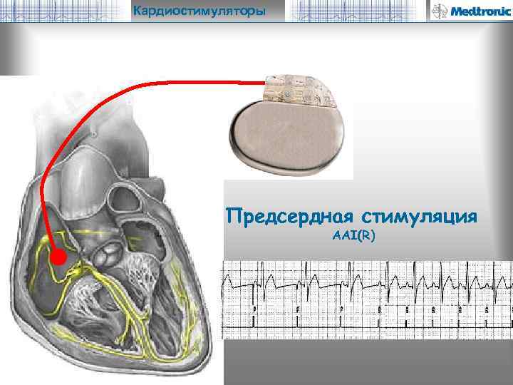 Кардиостимуляторы Предсердная стимуляция AAI(R) 