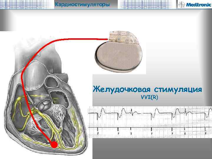 Кардиостимуляторы Желудочковая стимуляция VVI(R) 