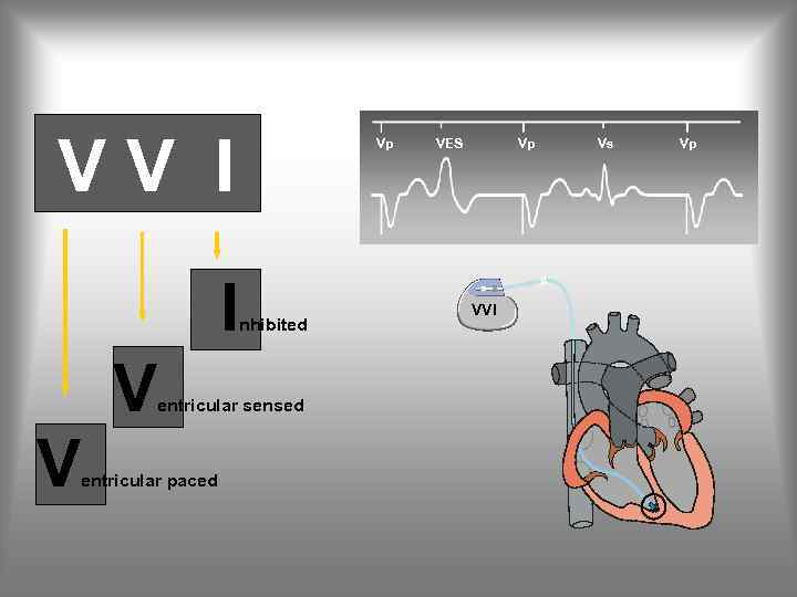 VV I I V V Vp nhibited entricular sensed entricular paced VES Vp VVI