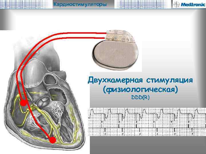 Кардиостимуляторы Двухкамерная стимуляция (физиологическая) DDD(R) 