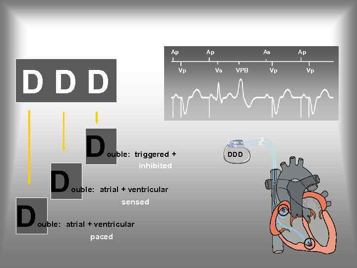 Ap DDD D Vp ouble: triggered + inhibited ouble: atrial + ventricular sensed ouble: