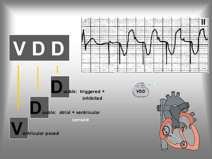 As VDD D D V Vp ouble: triggered + inhibited ouble: atrial + ventricular