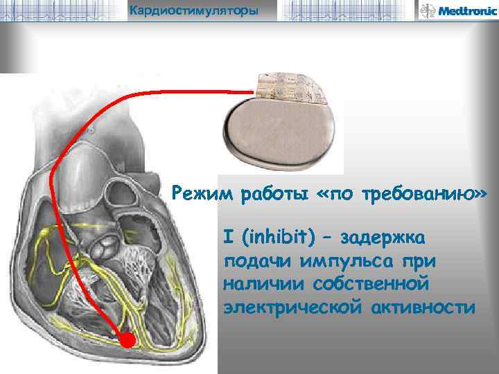 Кардиостимуляторы Режим работы «по требованию» I (inhibit) – задержка подачи импульса при наличии собственной