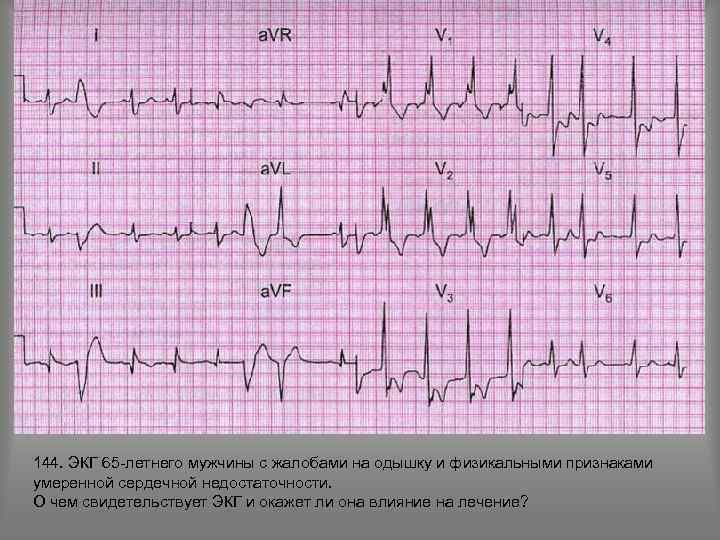 144. ЭКГ 65 -летнего мужчины с жалобами на одышку и физикальными признаками умеренной сердечной