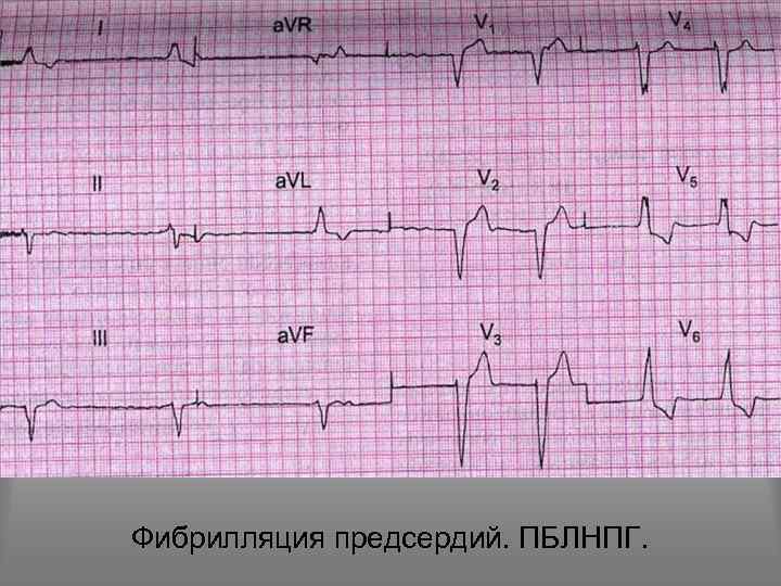 Фибрилляция предсердий. ПБЛНПГ. 