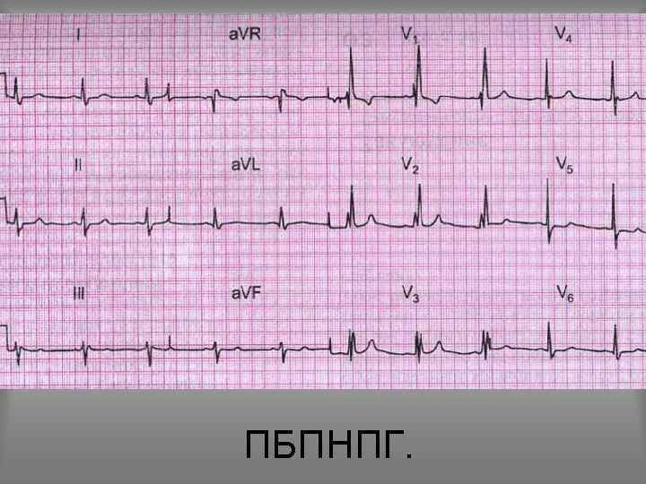 ПБПНПГ. 