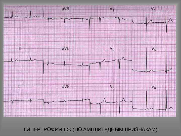 ГИПЕРТРОФИЯ ЛЖ (ПО АМПЛИТУДНЫМ ПРИЗНАКАМ) 