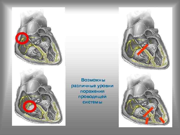 Возможны различные уровни поражения проводящей системы 