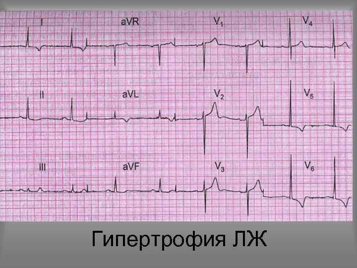 Гипертрофия ЛЖ 