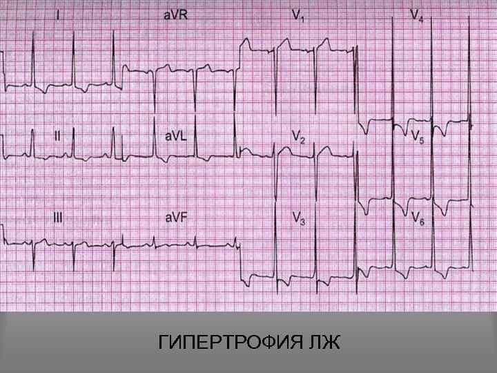 ГИПЕРТРОФИЯ ЛЖ 