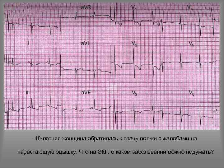 40 -летняя женщина обратилась к врачу пол-ки с жалобами на нарастающую одышку. Что на