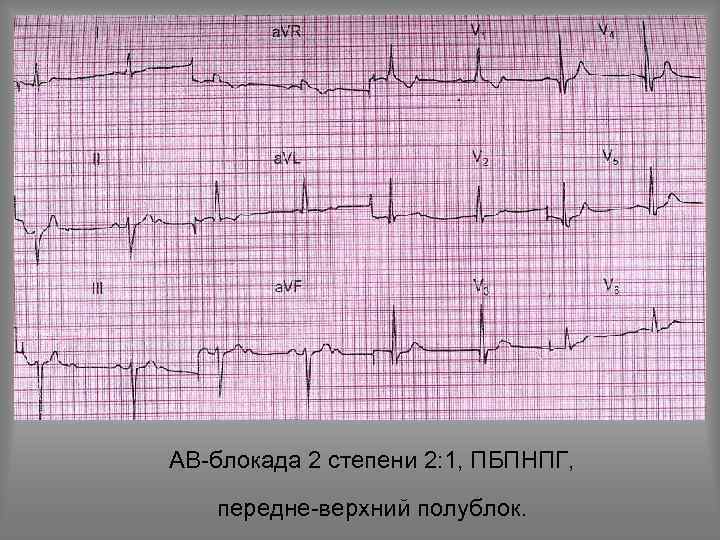 АВ-блокада 2 степени 2: 1, ПБПНПГ, передне-верхний полублок. 