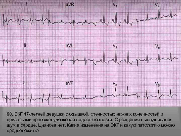90. ЭКГ 17 -летней девушки с одышкой, отечностью нижних конечностей и признаками правожелудочковой недостаточности.