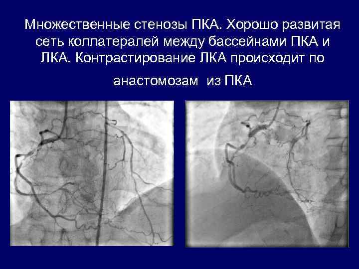 Множественные стенозы ПКА. Хорошо развитая сеть коллатералей между бассейнами ПКА и ЛКА. Контрастирование ЛКА