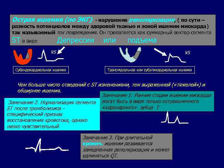 Острая ишемия (по ЭКГ) - нарушение реполяризации, ( по сути – разность потенциалов между