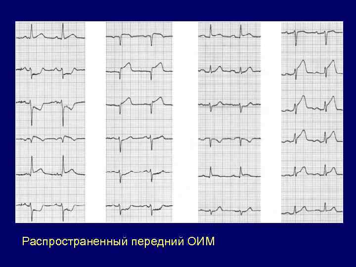 Распространенный передний ОИМ 