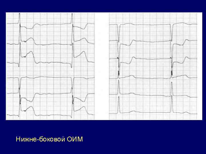 Нижне-боковой ОИМ 