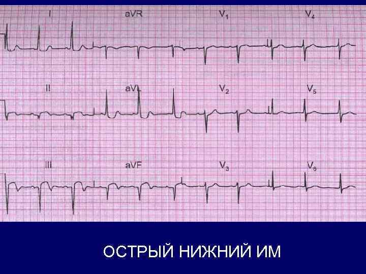 ОСТРЫЙ НИЖНИЙ ИМ 