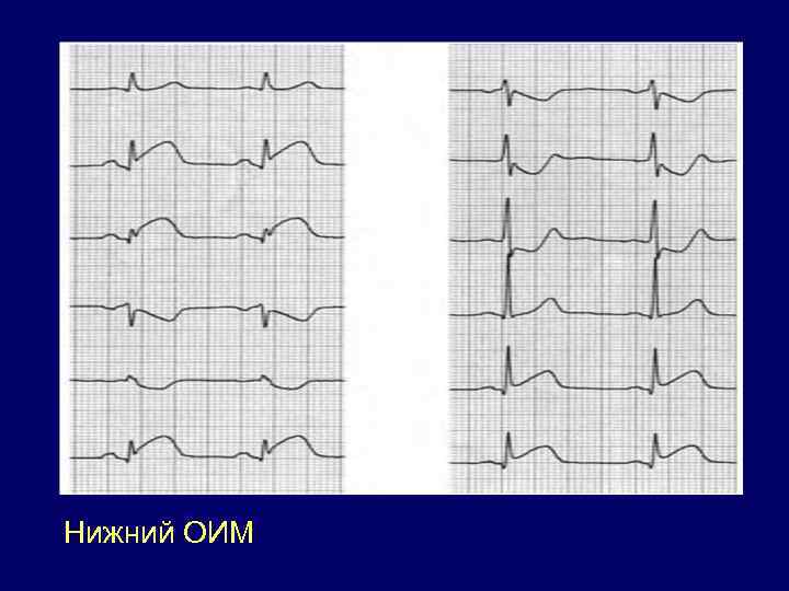 Оим фото экг