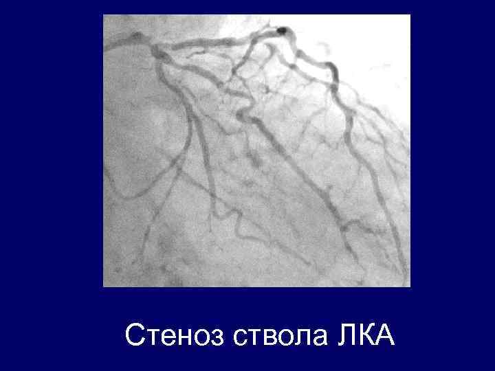 Левый ствол. Окклюзия ствола левой коронарной артерии ЭКГ. Стентирование ствола левой коронарной артерии. Стеноз ствола левой коронарной артерии. ЭКГ при стенозе ствола левой коронарной артерии.