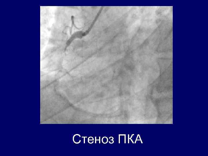 Стеноз ПКА 