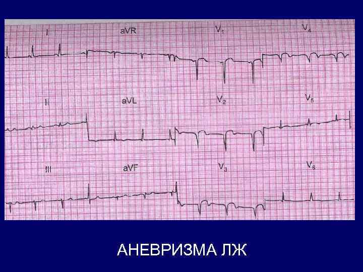 АНЕВРИЗМА ЛЖ 