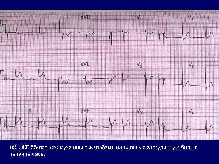89. ЭКГ 55 -летнего мужчины с жалобами на сильную загрудинную боль в течение часа.