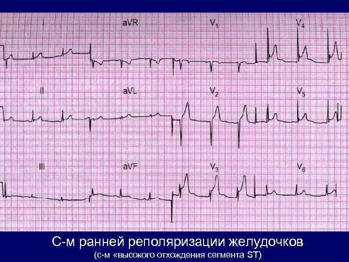 Реполяризация желудочков на экг. Ранняя реполяризация желудочков на ЭКГ. Синдром ранней реполяризации миокарда желудочков на ЭКГ. Феномен РРЖ на ЭКГ. Ранняя реполяризация желудочков сердца на ЭКГ.