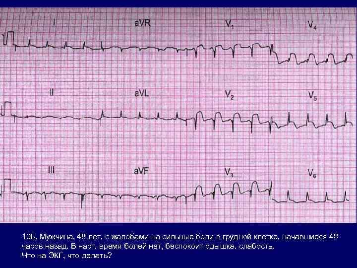 106. Мужчина, 48 лет, с жалобами на сильные боли в грудной клетке, начавшиеся 48