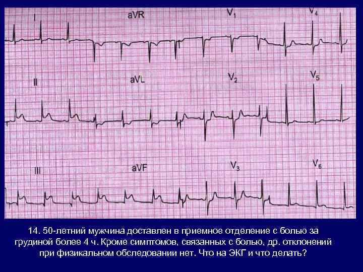14. 50 -летний мужчина доставлен в приемное отделение с болью за грудиной более 4