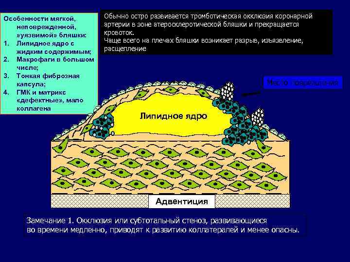 Особенности мягкой, неповрежденной, » уязвимой» бляшки: 1. Липидное ядро с жидким содержимым; 2. Макрофаги