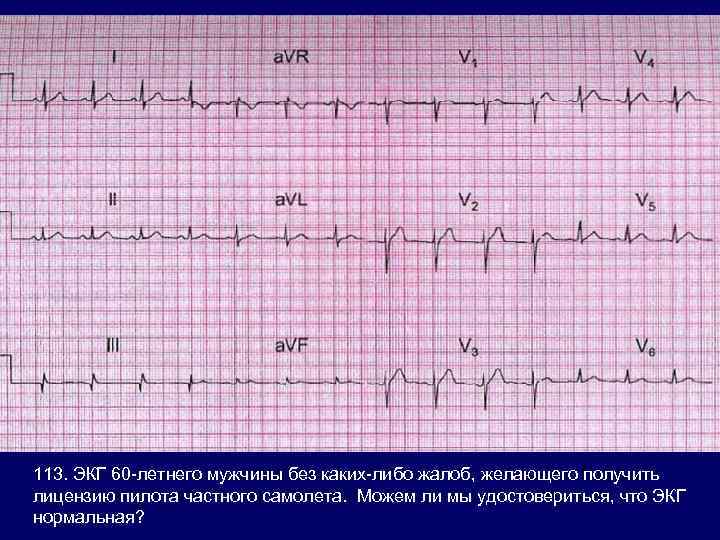 113. ЭКГ 60 -летнего мужчины без каких-либо жалоб, желающего получить лицензию пилота частного самолета.