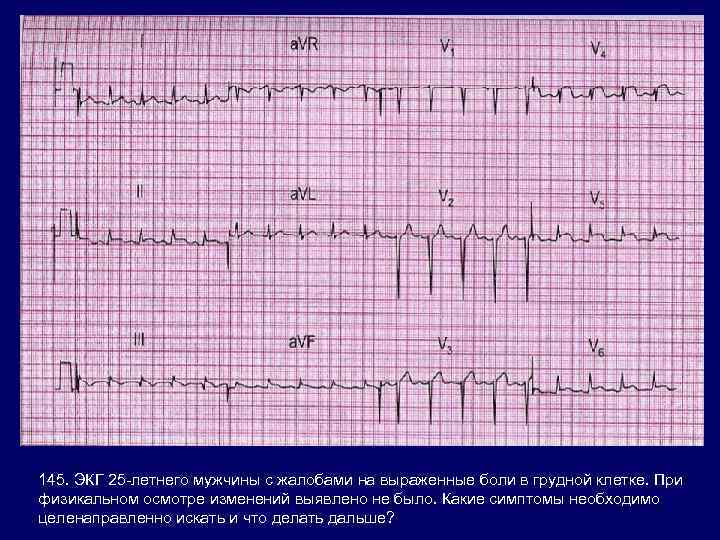 145. ЭКГ 25 -летнего мужчины с жалобами на выраженные боли в грудной клетке. При